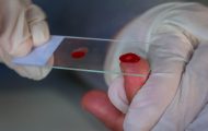 diagnosticos-e-tratamentos-para-malaria-e-hepatites-virais-sao-oferecidos-pelo-centro-de-pesquisa-em-medicina-de-rondonia